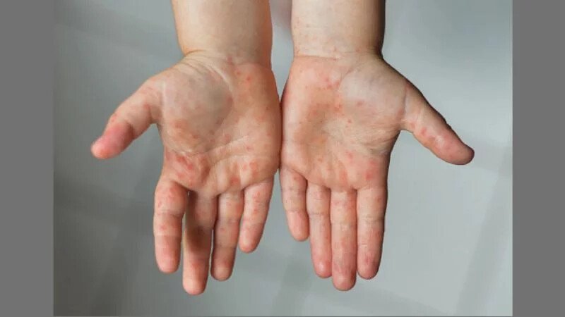 সিলেটে হামের উপসর্গে আরও দুই শিশুর মৃ’ত্যু, একজন মৌলভীবাজারের